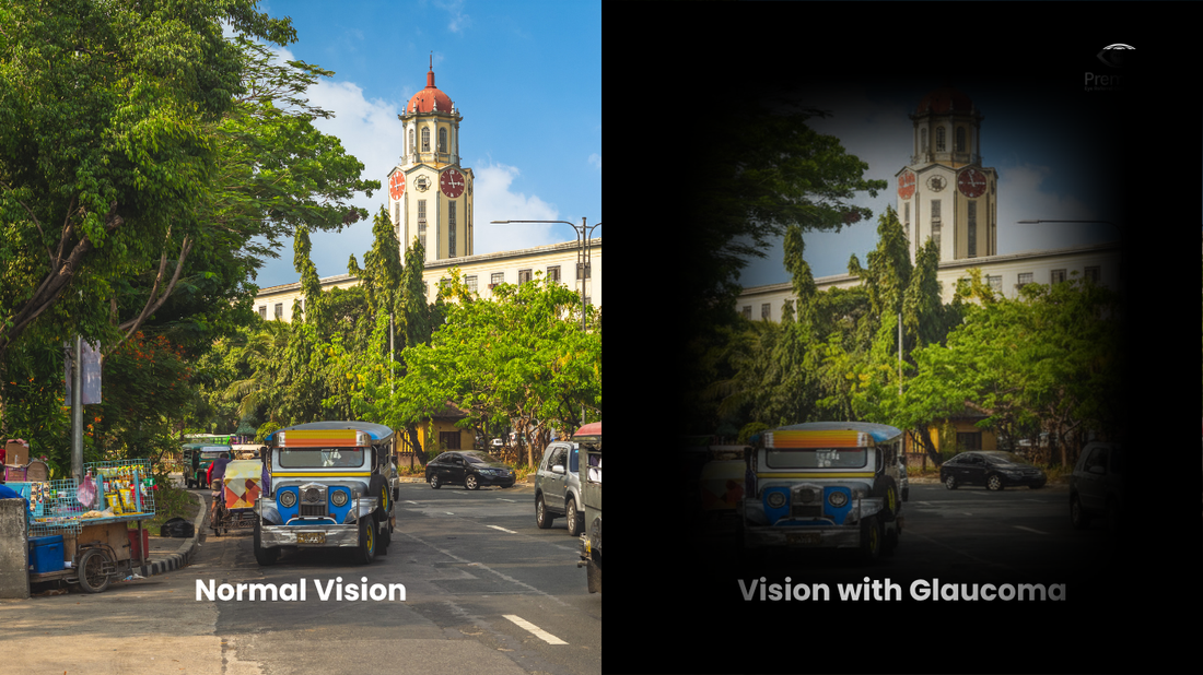Glaucoma: Understanding the Silent Thief of Sight