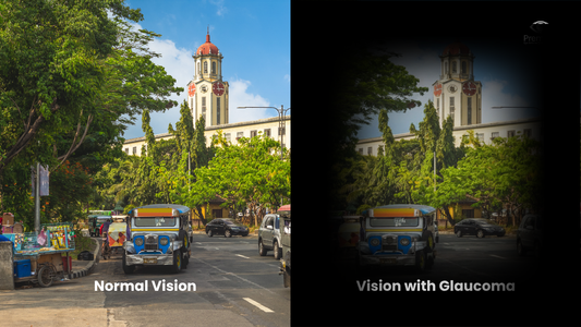Glaucoma: Understanding the Silent Thief of Sight